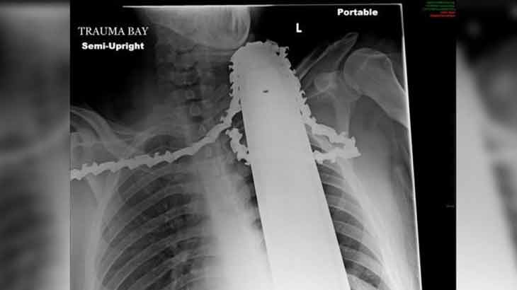 zreay chainsaw accident