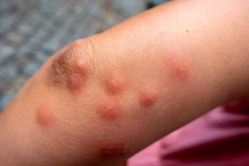 Is it harmful to live with bedbugs